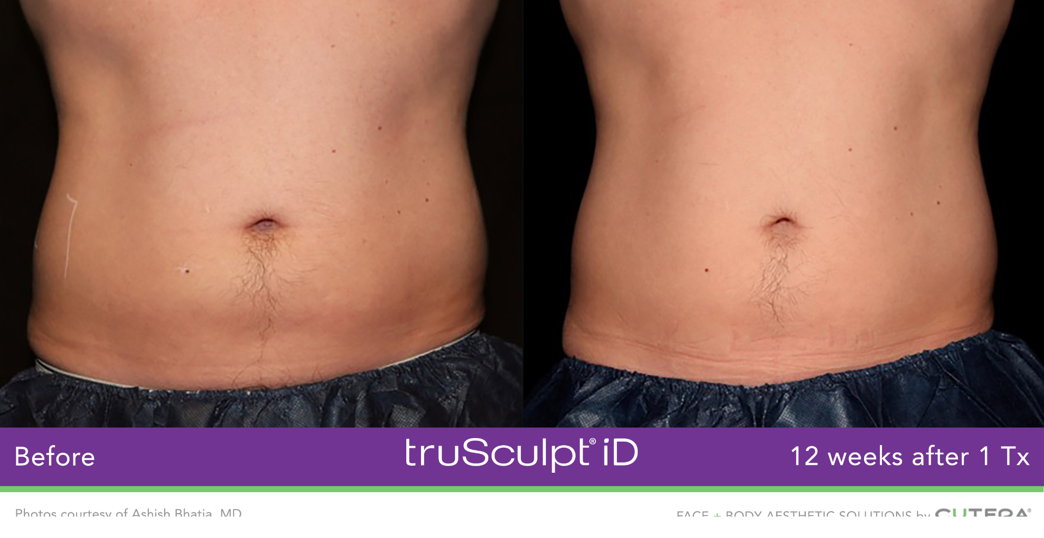 Body Sculpting: What is it & How Does it Work? – Introlift Medical Spa,  Sculpting 